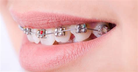 swallowed metal bracket braces|swallowing braces bracket.